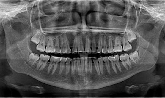 Radiografia Panoramica