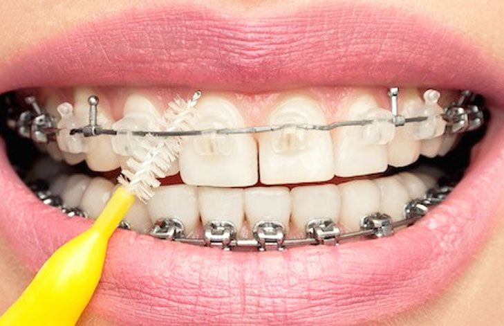 Tips para pacientes con brackets