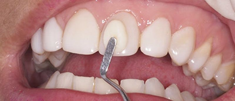 Qué es una resina dental? | DENTAL KREBS ®
