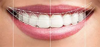 Diseño de Sonrisas dientes