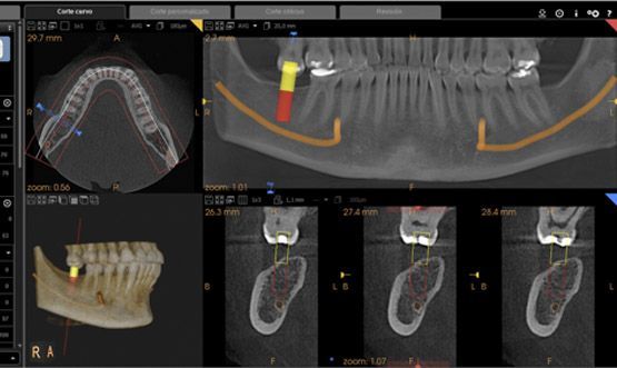 Tomografia Oral