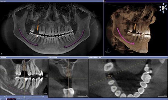 Tomografia Implantes